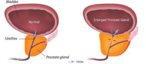 Ki gyógyította a prosztatitis pieches- t Prosztata ovulációval