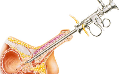 Διουρηθρική αφαίρεση θηλωμάτων